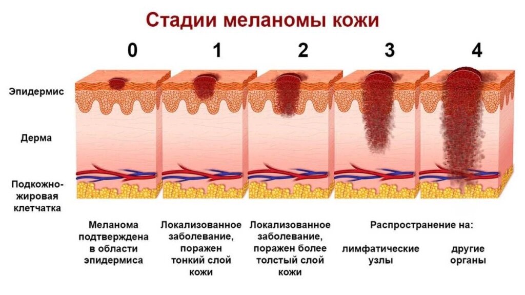 Меланома — это злокачественная опухоль, которая развивается из меланоцитов, клеток, производящих меланин — пигмент, придающий цвет коже, волосам и глазам.