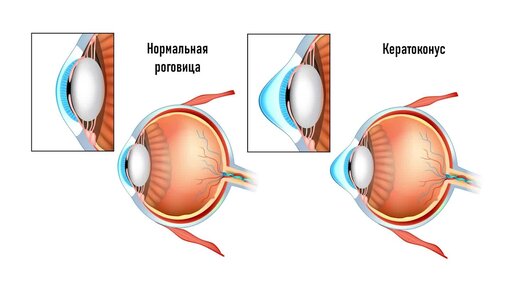 Кератоконус: что это такое, симптомы кератоконуса. Кросслинкинг роговицы глаза