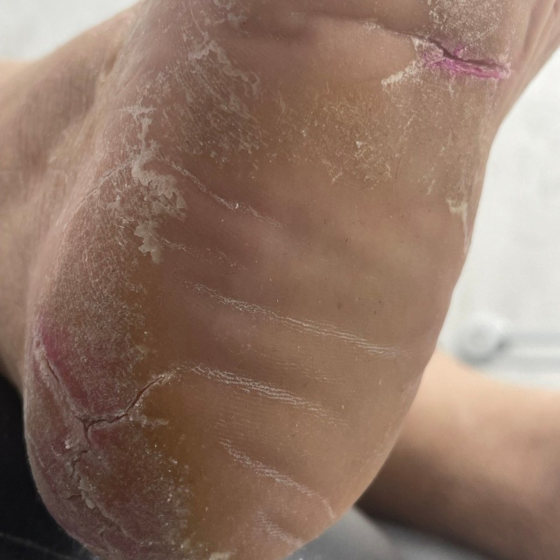 Кератодермия — это группа заболеваний, характеризующееся усиленным ороговением и стойким утолщением кожи, по статистике чаще встречается у женщин. На что жалуется клиент, когда обращается к нам?