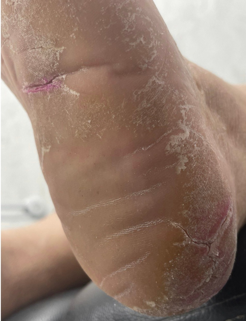 Кератодермия — это группа заболеваний, характеризующееся усиленным ороговением и стойким утолщением кожи, по статистике чаще встречается у женщин. На что жалуется клиент, когда обращается к нам?-4