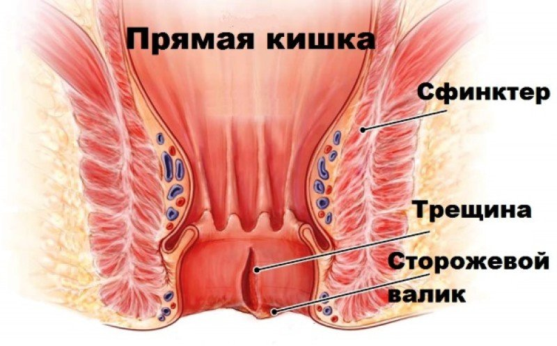 Острые и хронические анальные трещины: отличия, симптомы, лечение