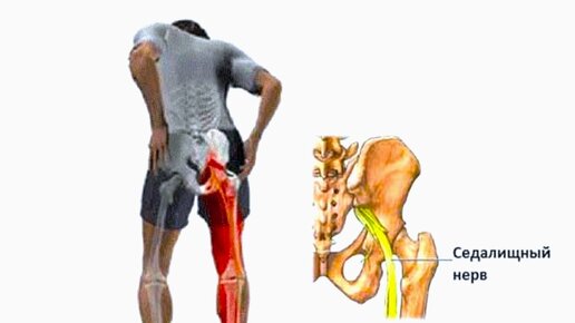 Как разблокировать седалищный нерв без боли