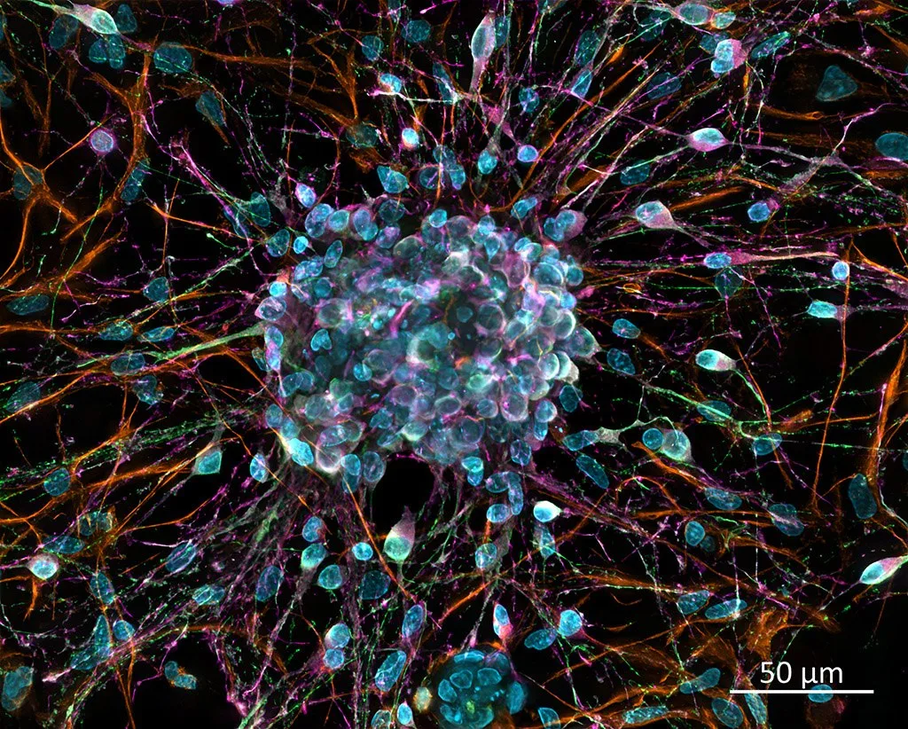 Why nerve cells die in ALS and frontotemporal EurekAlert!