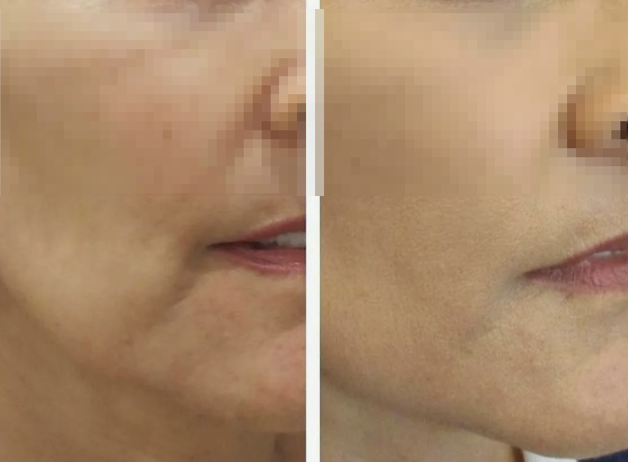  действие рестилайна  до и после