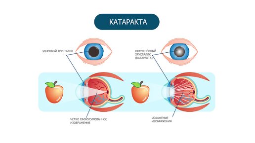 Признаки катаракты глаза. Зрелая и незрелая катаракта, старческая и ядерная