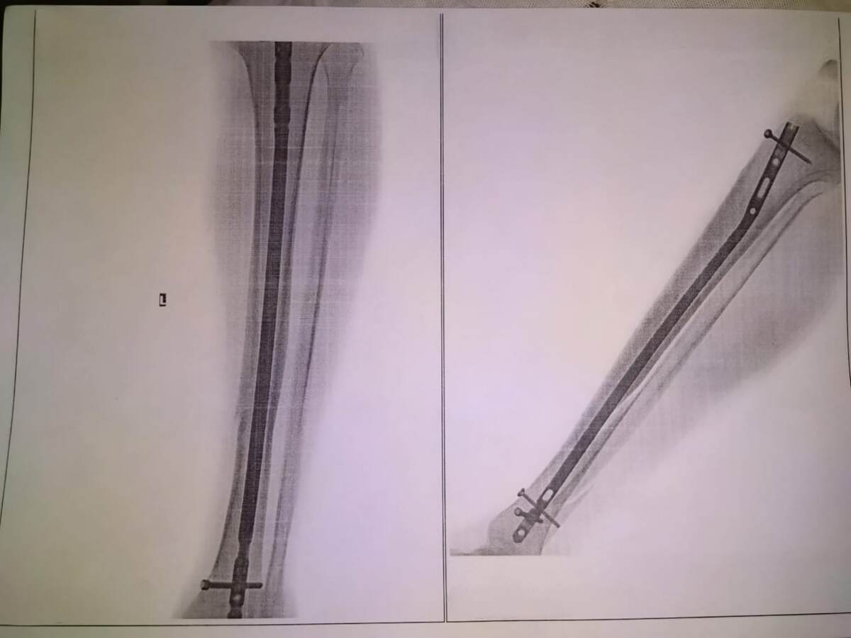Контрольный рентген моей ноги на следующий день после операции