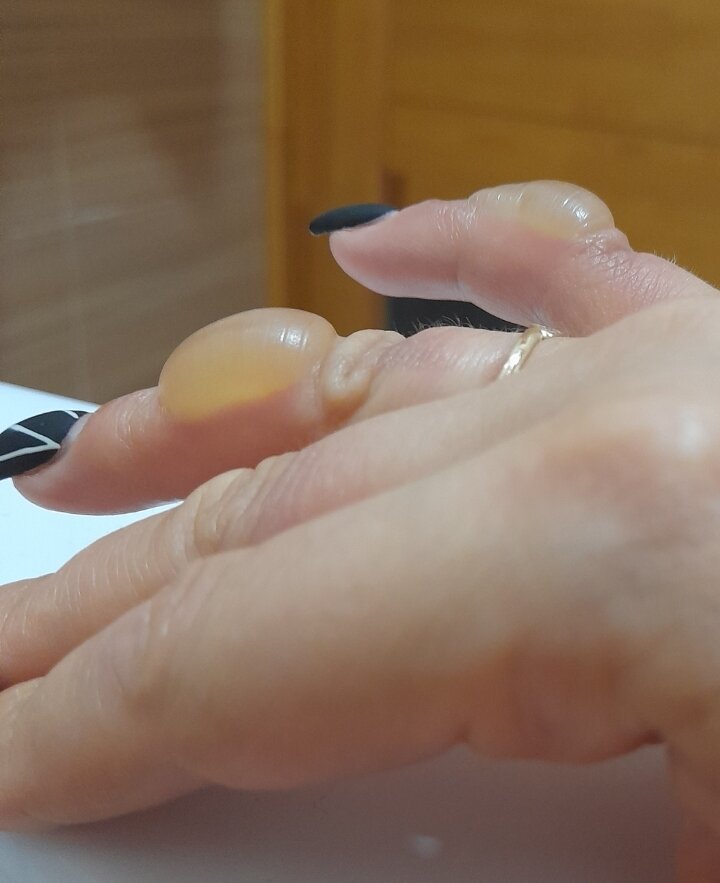 Ожог. 5 июня