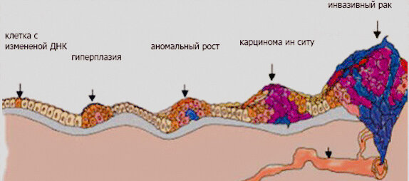  Рак in situ (инситу) молочной железы