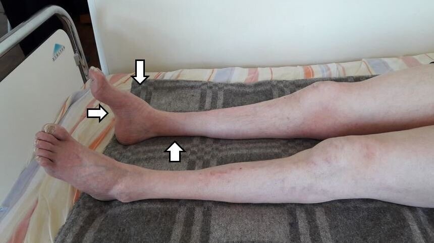 Признаки гипотрофии мышц нижних конечностей с деформацией стоп у пациента с полинейропатией Шарко–Мари–Тута. Собственный архив.