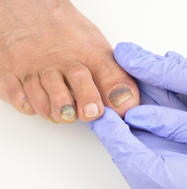 Грибок ногтей