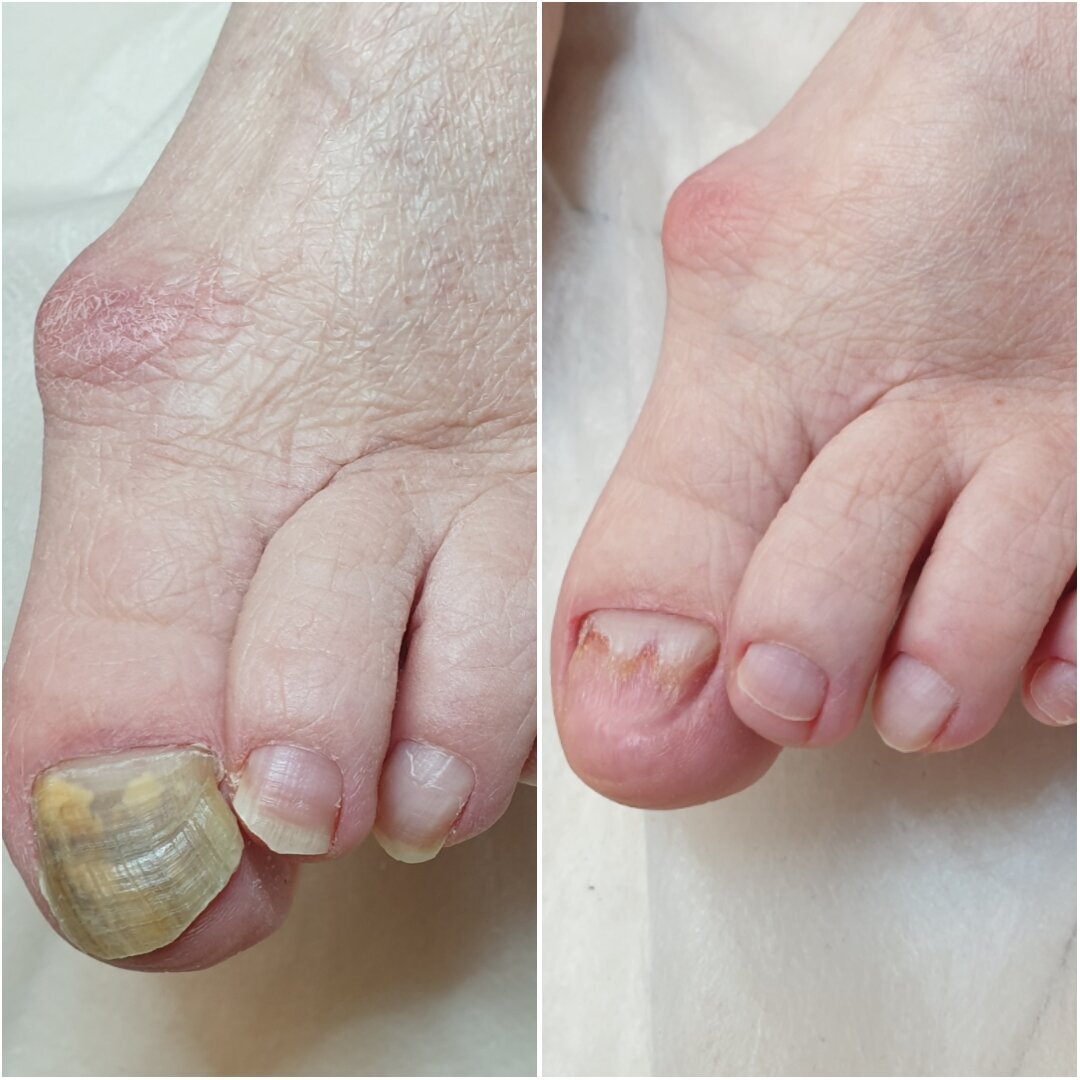 Удаление грибка ногтей