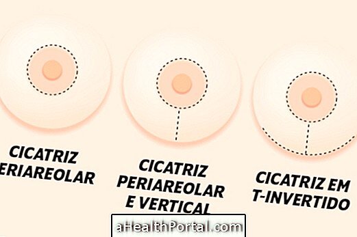 Различные виды разрезов при разных вариантах подтяжки 