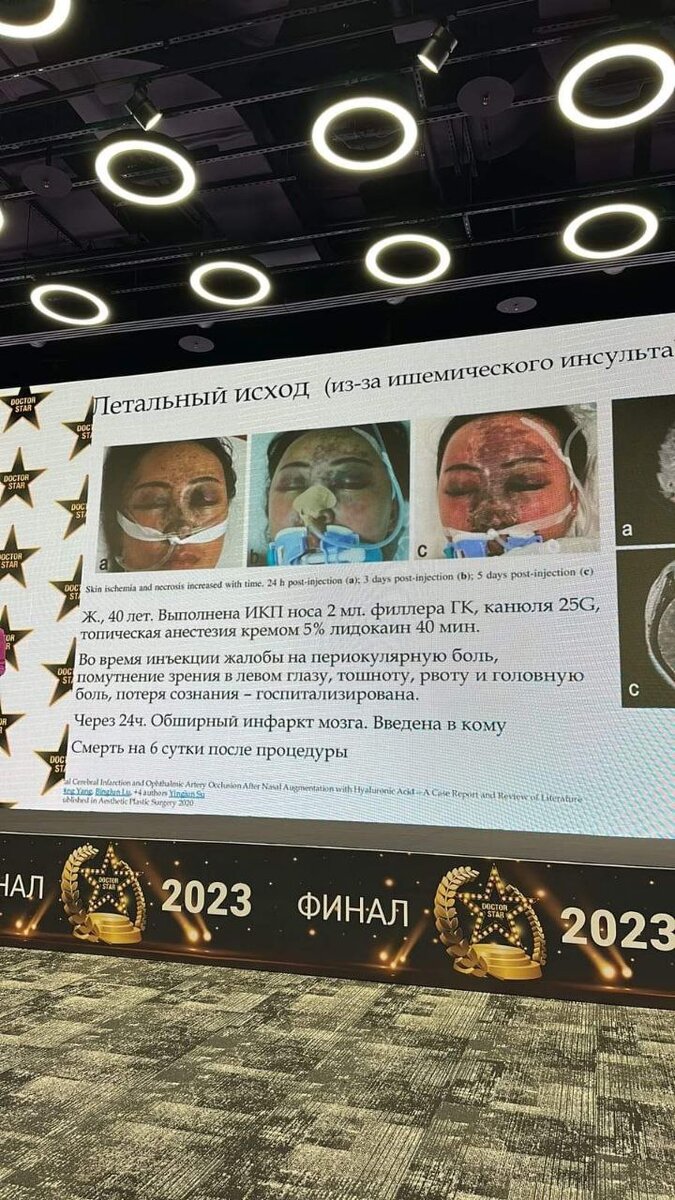 Потому что получила свое первое осложнение - ишению в зоне спинки носа, которую потом лечили и на стрессе потеряла половину волос. 

И да, это ОЧЕНЬ опасная зона. Она становится КРИТИЧНО опасной в случае проведения хирургической ринопластики и попытках "доработать" недочеты хирургии - филлером. 

Опасна зона тем, что там очень близко расположены сосуды и фактически нет коллатералей. Это значит, пережав сосуд филлером мы можем получить ишемию. Это значит, попадая филлером в просвет сосуда, мы можем ослепнуть или умереть, как к сожалению случилось в истории на фото. 

Спасибо коллеге, который прислал эту историю. Ещё одна страшилка в копилку.

Автор поста доктор Анна Смольянова.