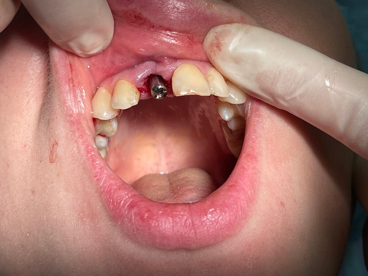 Проверка позиционирования импланта