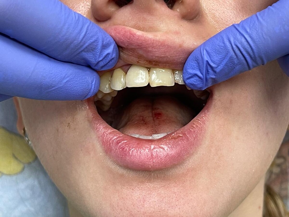 Немедленная нагрузка коронкой