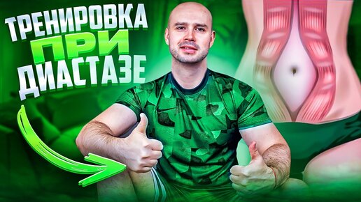 Диастаз прямых мышц живота на кт
