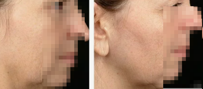 микроигольная мезотерапия до и после