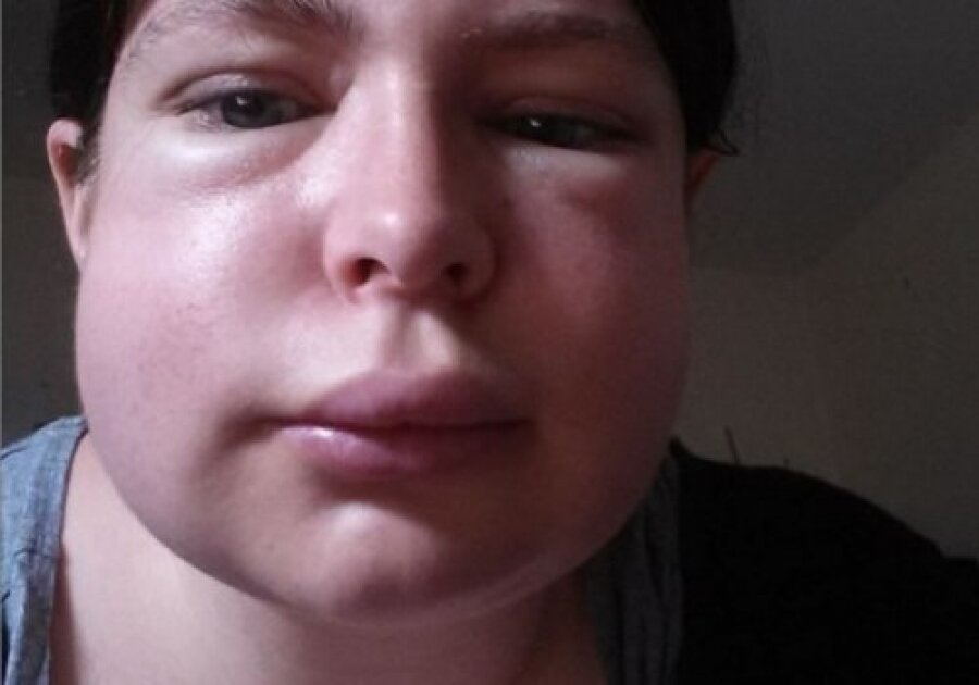 отекший парень