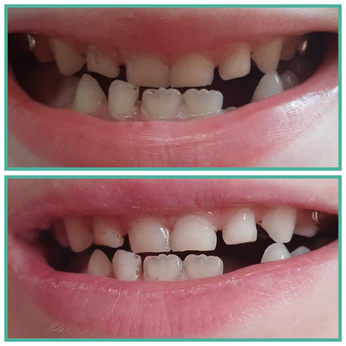 Верхнее- начало лечения. Нижнее- спустя 15 дней