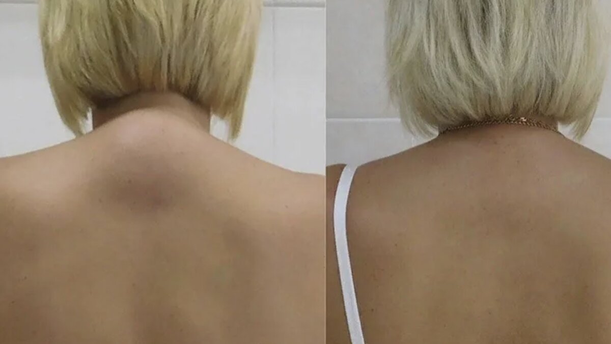 Лазерный липолиз вдовий горб. Липолитики для холки на шее. Липосакция шейного горба. Липосакция вдовьего горба. Климактерический горбик.