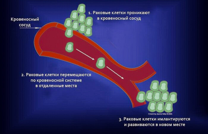 Механизмы метастазирования