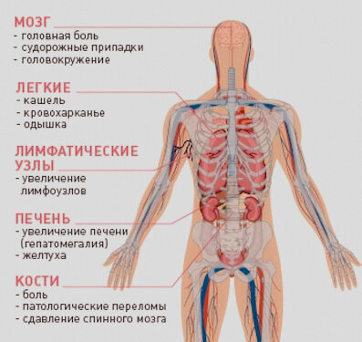 Особенности метастазирования разных типов рака