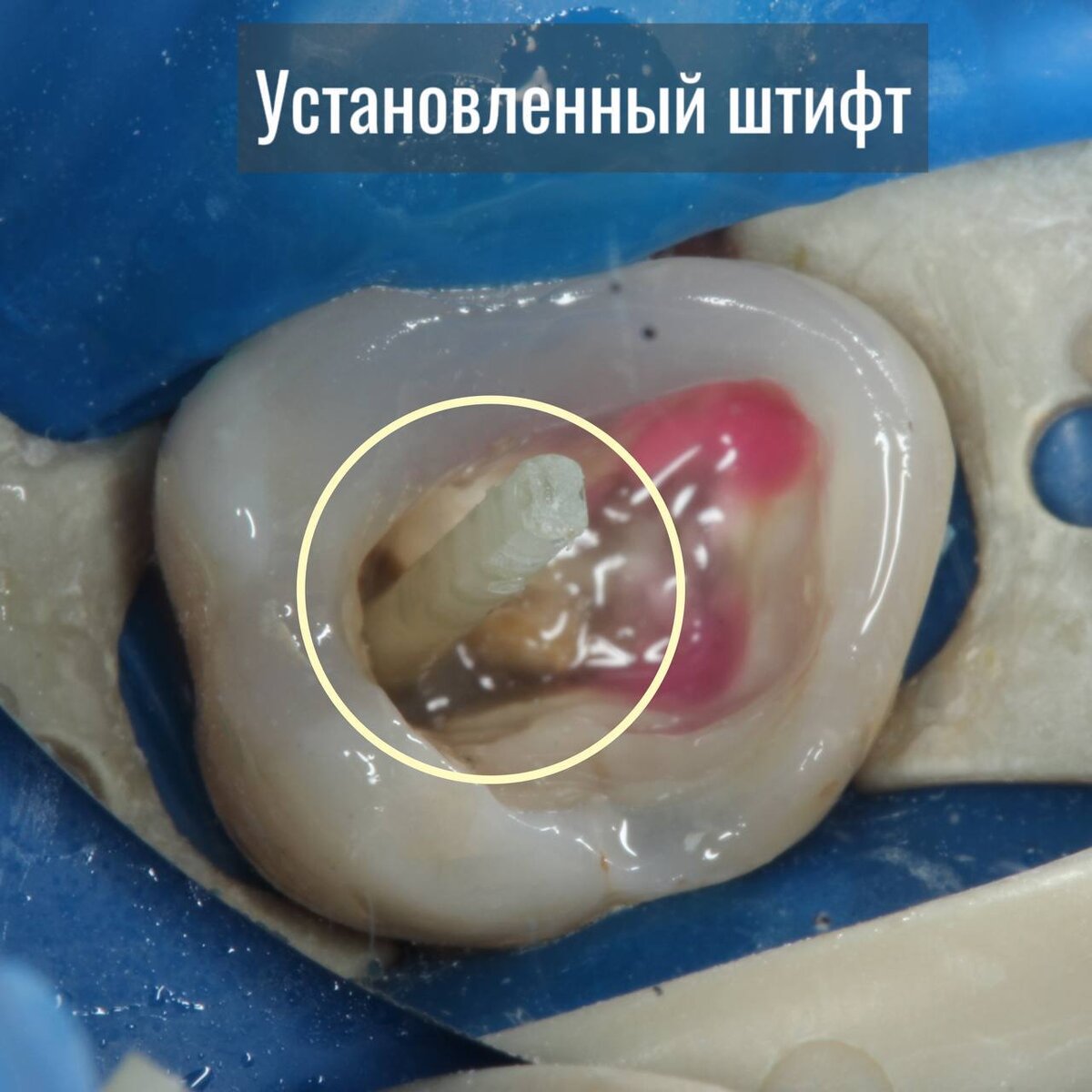 После проведения перелечивания каналов в один из них был установлен стекловолоконный штифт. А оставшаяся часть зуба восстановлена композитным пломбировочным материалом. 