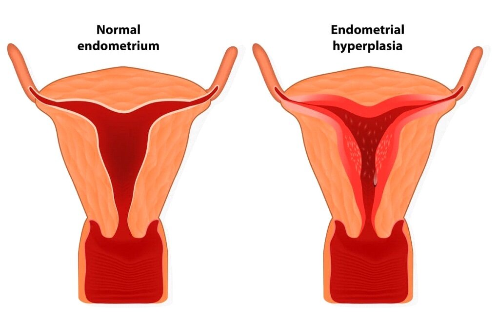 Гиперплазия эндометрия –  это патологический процесс, развивающийся во внутренней (слизистой) оболочке матки.