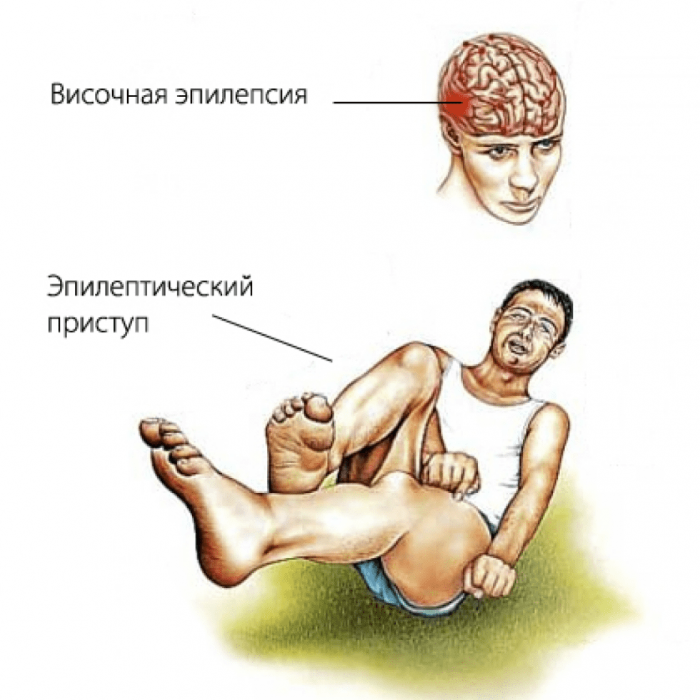 Приступы эпилепсии: чем опасны судороги и как жить с этой патологией? | О  здоровье: с медицинского на русский | Дзен