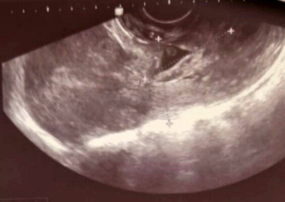 На фото- тело матки и шейка матки.  В верхней трети цервикального канала визуализируется плодное яйцо с эмбрионом. 