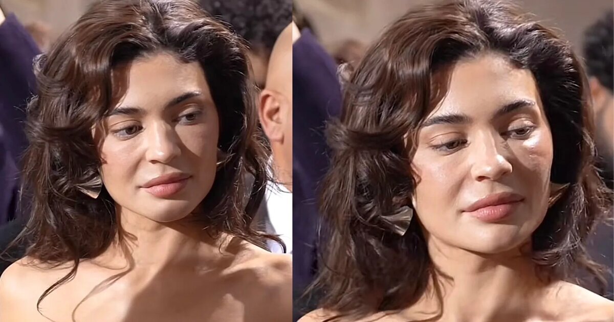 Из-за филлеров часто скапливается лишняя жидкость, лицо опухает 