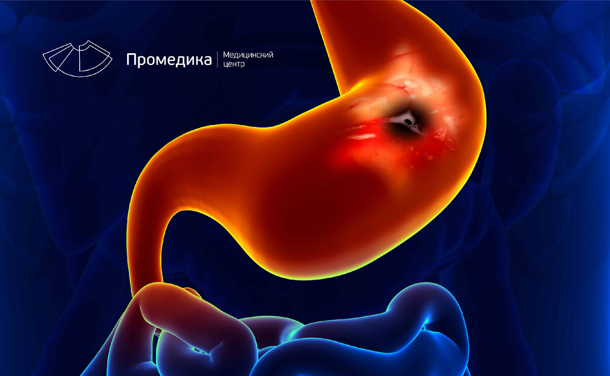 Как узнать, что у вас гастрит: ранние симптомы и сигналы тревоги