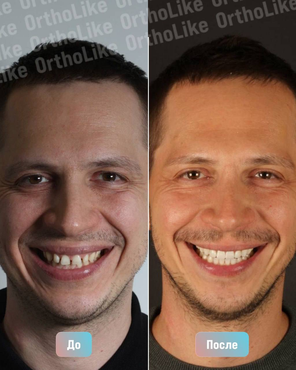 До и после лечения