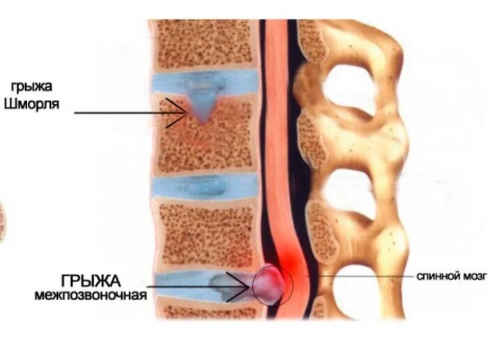 Грыжа Шморля , грыжа межпозвонкового диска ( не путаем) 