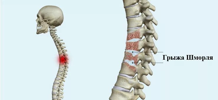 Грыжи Шморля Тh 4-Th6 позвонков