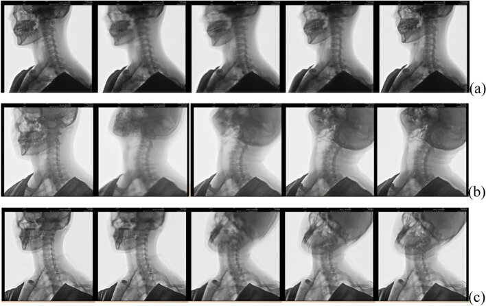 Лечебные упражнения для позвоночника: ретракции шейного отдела позвоночника (а), разгибания ( б ) и латерального сгибания ( в ) в сторону очага поражения с целью уменьшения смещения ядра и периферизации внутри диска.