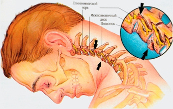 Верхняя стрелка указывает на сдавление корешка грыжей межпозвонкового диска.