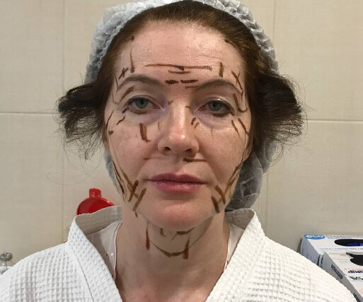 разметка перед операцией. фото из личного архива пациентки 