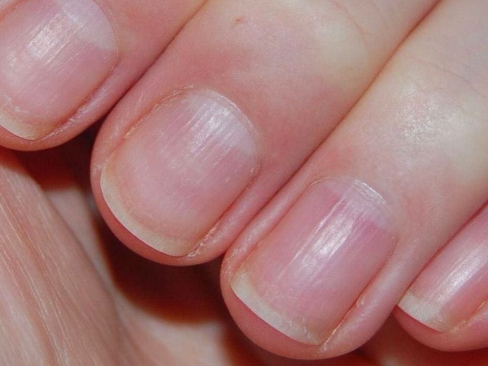 Почему ногти стали ребристыми и что делать в таком случае