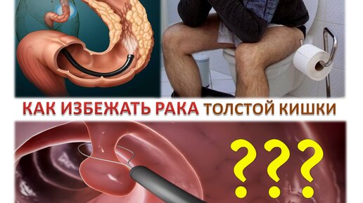 Download Video: Как избежать рака толстой кишки? Самая лучшая профилактика. Простыми словами о раке кишечника.