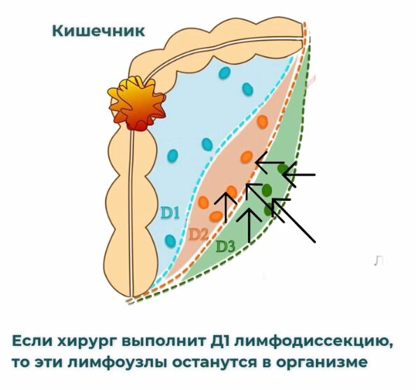 Хотелось бы обратить внимание, что невидимые клетки на то и невидимые, что даже самый тщательно выбранный хирург их не увидит и не удалит.