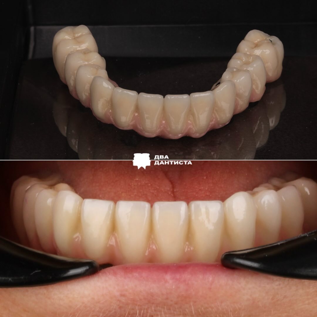 Какой протез поставить на верхнюю и нижнюю челюсть? | Два Дантиста | Дзен