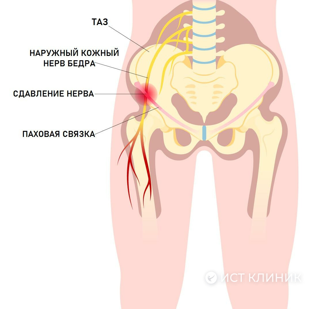 Тазовая невралгия - защемление нерва в тазобедренном суставе