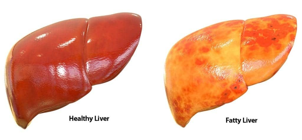 иллюстрация с сайта Американского фонда печени https://liverfoundation.org/liver-diseases/fatty-liver-disease/nonalcoholic-steatohepatitis-nash/nash-definition-prevalence/