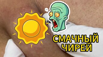 Выдавливание огромного прыща на спине. Гной вылетает очень эпично. Залипательное зрелище