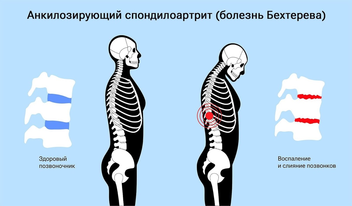 Радикулит: симптомы, виды и причины. Методы лечения радикулита — объясняет  врач | Клиника доктора Шурова | Дзен