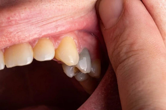 При пульпите инфекция поражает сосуды и нервы, расположенные внутри зуба.