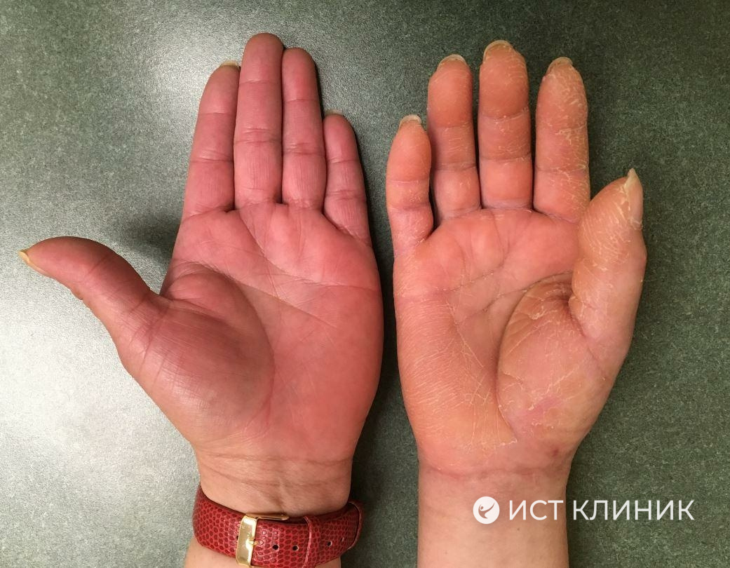 В основе синдрома Зудека лежит повреждение тончайших сенсорных и вегетативных нервных волокон