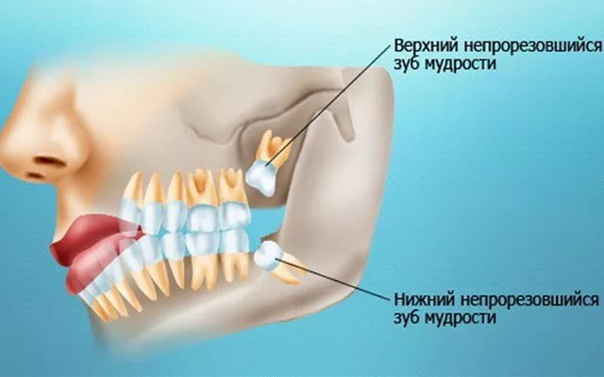 Рис 1. нахождение зубов мудрости в ротовой полости