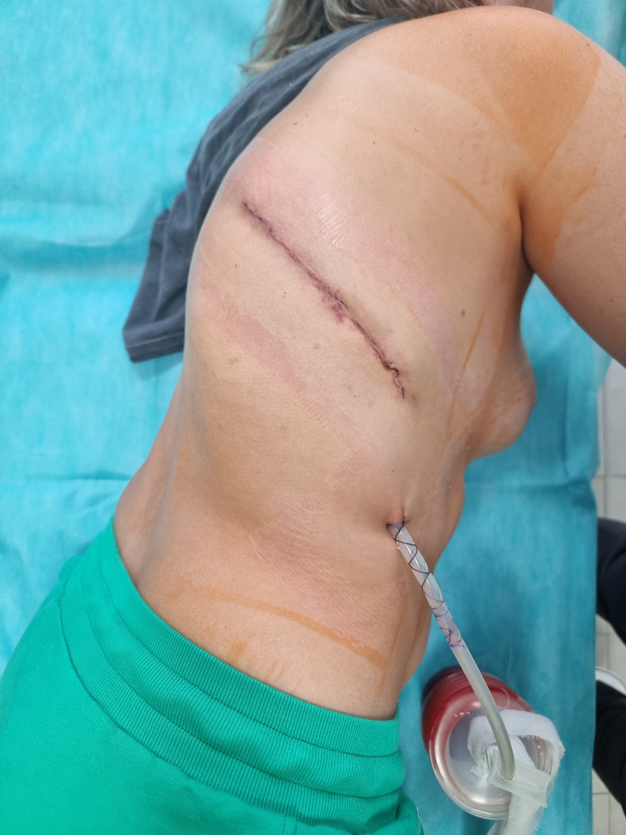 После удаления дисков ( основание диска оставляют, убирают часть)